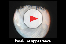 Pearl-like appearance