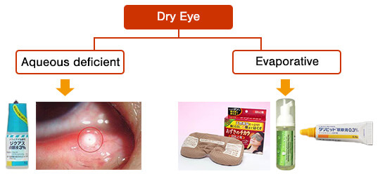 Fig. 2: Classification of dry eye