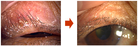 Fig. 3: A case where only lid hygiene was performed for 2 weeks and MGD was alleviated