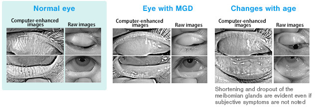 Fig. 3-b: Images from the Keratograph 5M (Photograph courtesy of: Shizuka Koh)