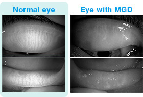 Fig. 1-b: L: Normal eye, R: Eye with MGD