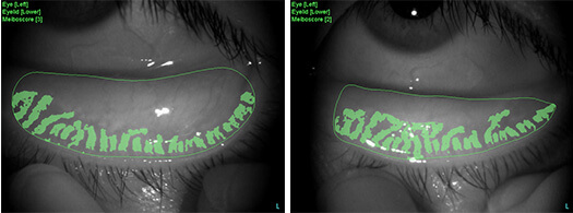 Fig. 4: A comparison of the region of the meibomian glands before and after treatment  The regions were depicted with the DC-4 and automatically analyzed with software