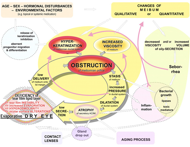 Fig .2 Pathophysiology of obstructive MGD.