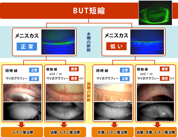 (図5)ドライアイ層別診療における油層診断