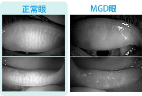 (図1-b)左：正常眼、右：MGD眼