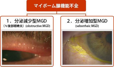 (図1) MGDの分類