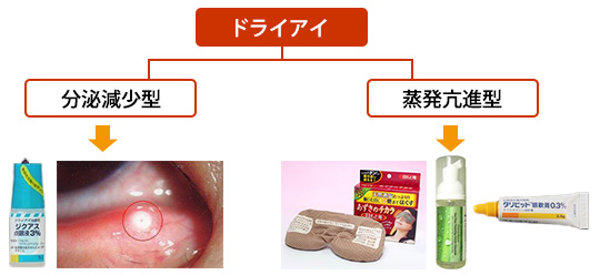 (図2)　ドライアイ分類