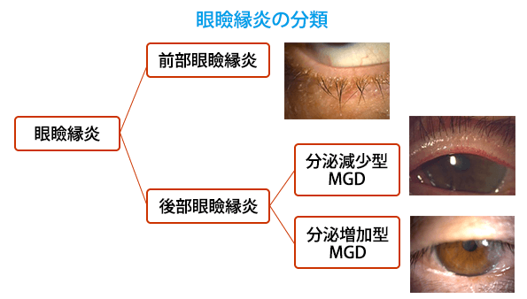 (図3)眼瞼縁炎の分類