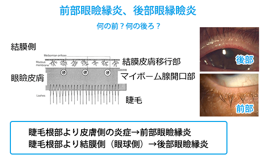 (図5)前眼部眼瞼縁炎、後部眼瞼縁炎