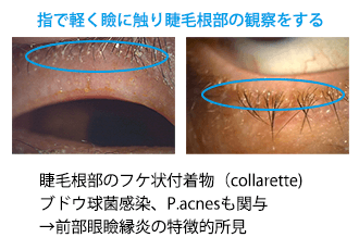 (図6)前部眼瞼縁炎診断のコツ