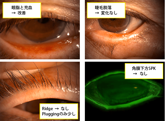  症例１：治療後１週間