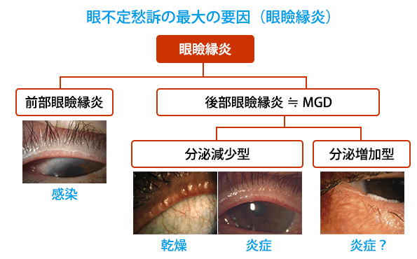  (図4)眼不定愁訴の最大の要因：眼瞼縁炎