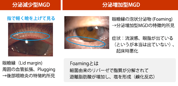 後部眼瞼縁炎診断のコツ<br>左：(図7)分泌減少型MGD、右：(図8)分泌増加型MGD