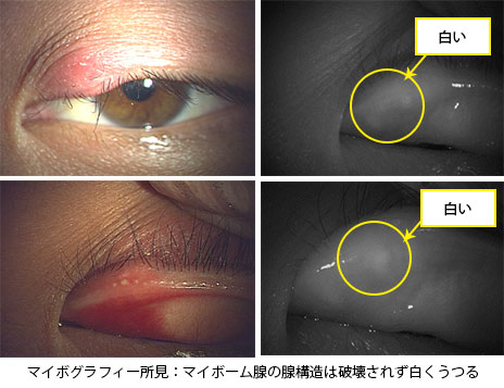 麦粒腫：28歳男性左眼。3日前から痛み。