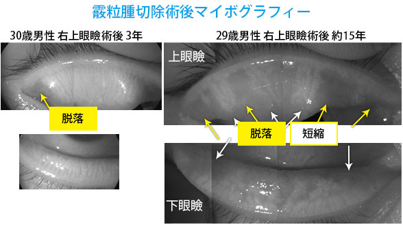 霰粒腫切除術後マイボグラフィー