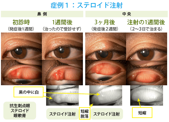 症例１：33歳　女性