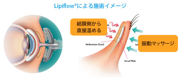 Lipiflow施術イメージ