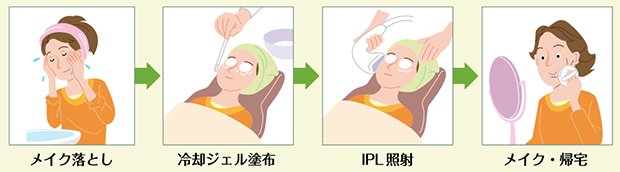 IPLの照射方法